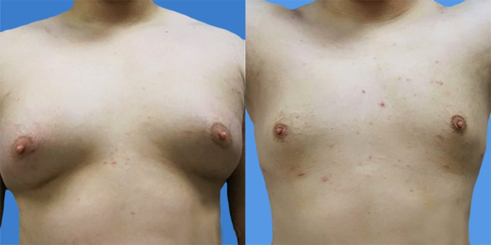 fettsuging liposkulptur